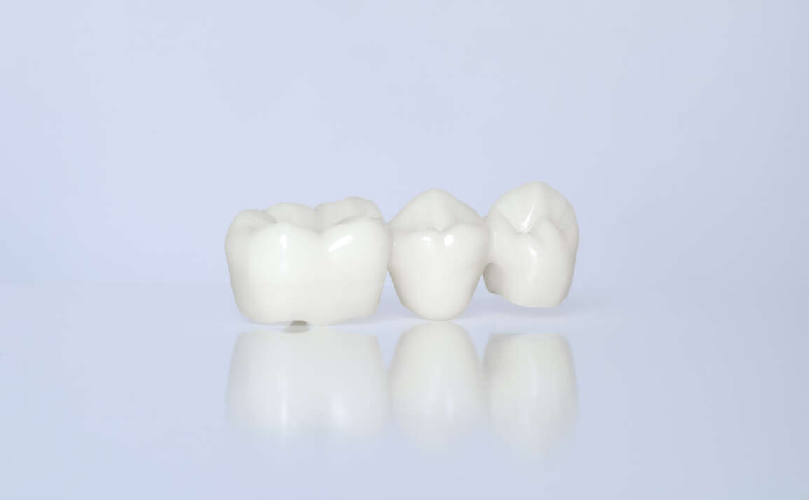 What to expect: Ceramic Restoration Procedure