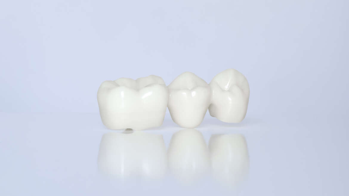 What to expect: Ceramic Restoration Procedure