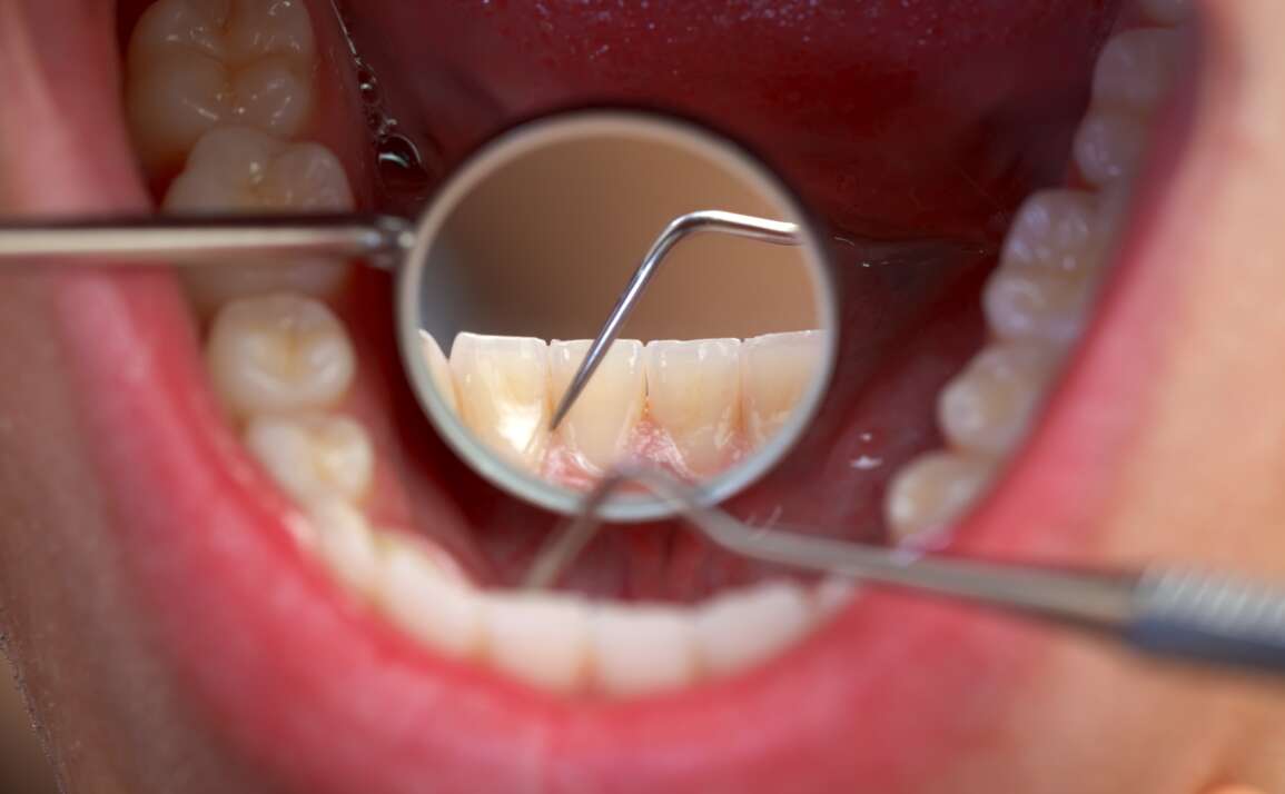 All about dental plaque