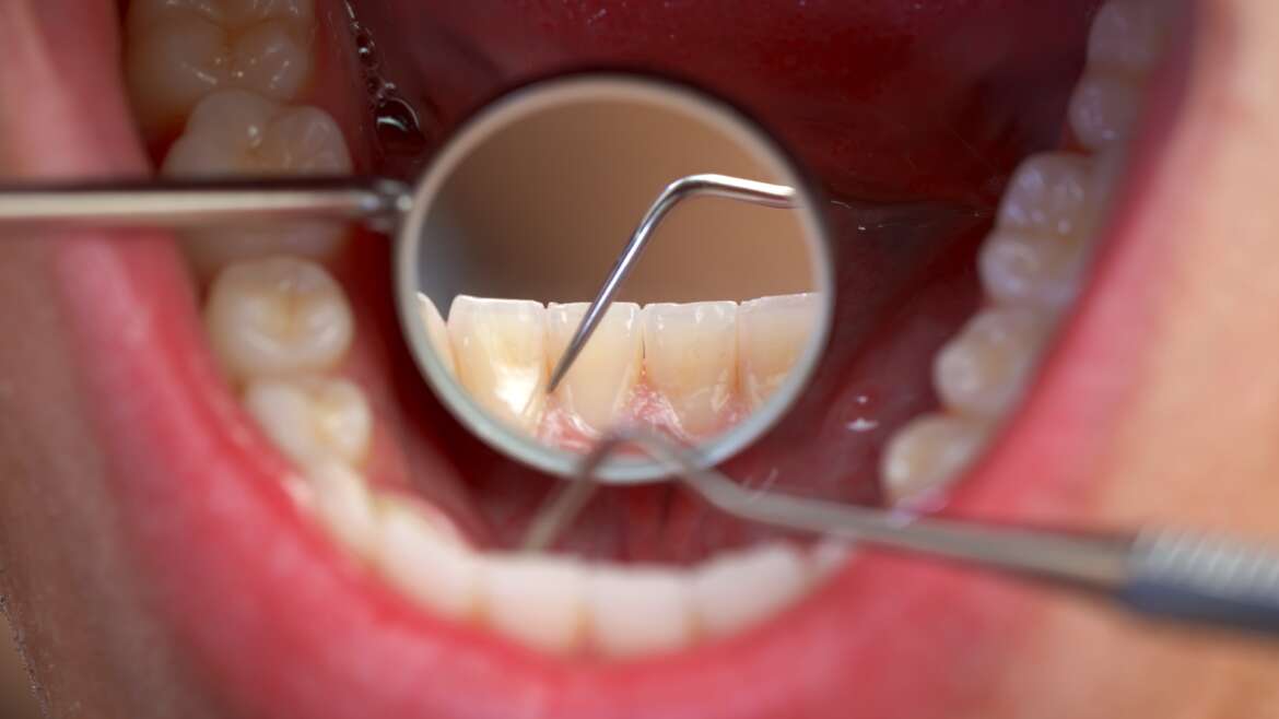 All about dental plaque