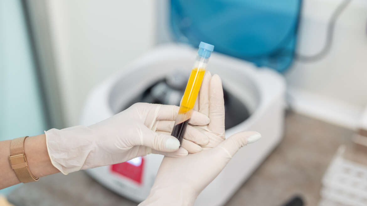 FAQ on Platelet Rich Plasma Therapy
