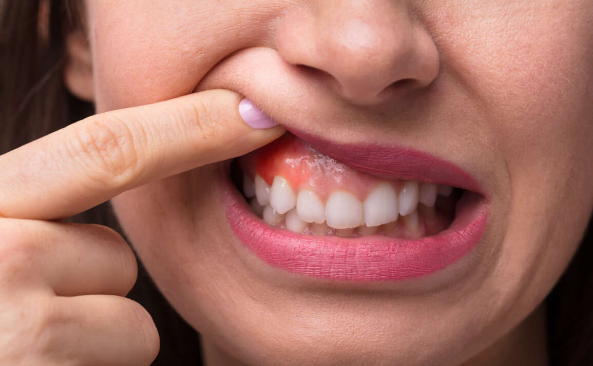 Are you experiencing gum boils?
