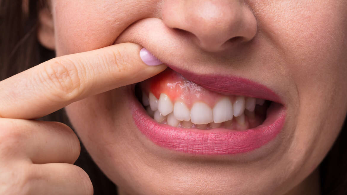 Are you experiencing gum boils?