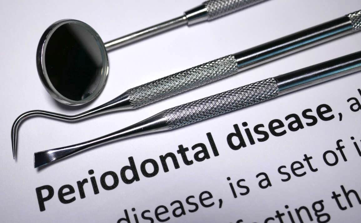 Treating Gum Disease