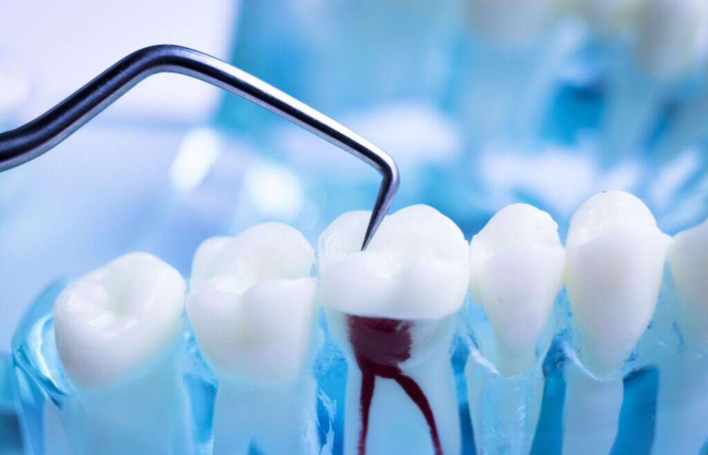 The 101 Of Root Canal Treatments