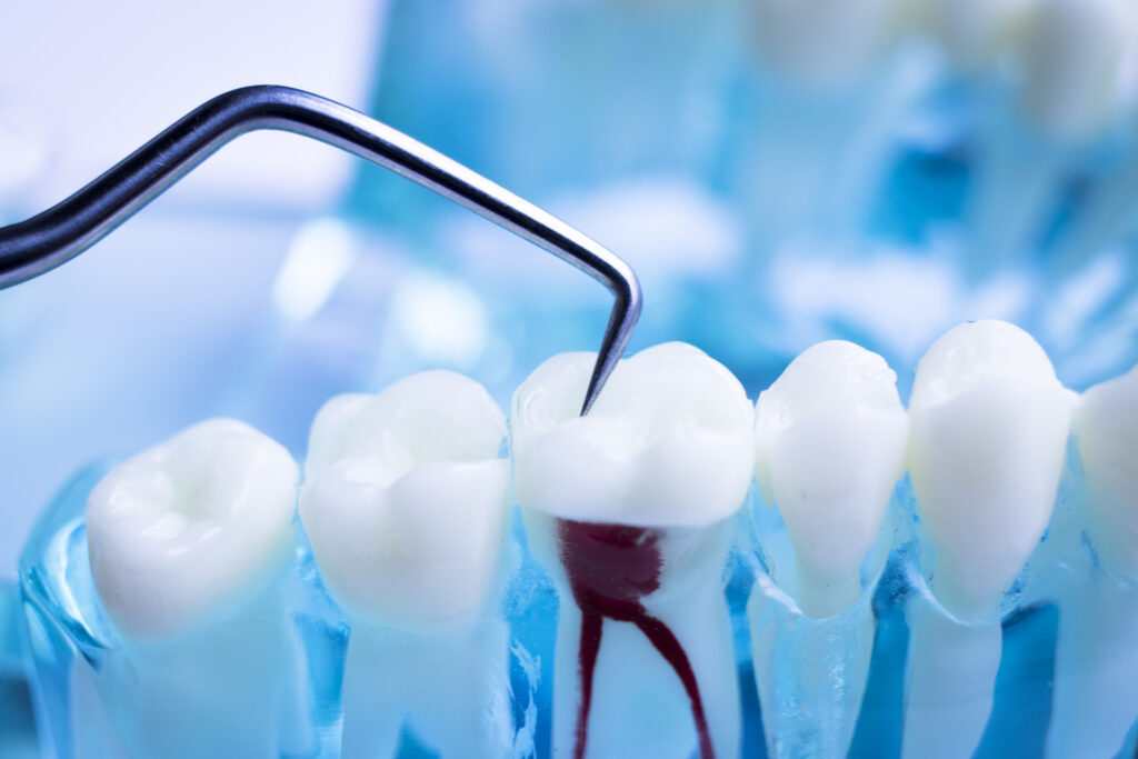 The 101 Of Root Canal Treatments