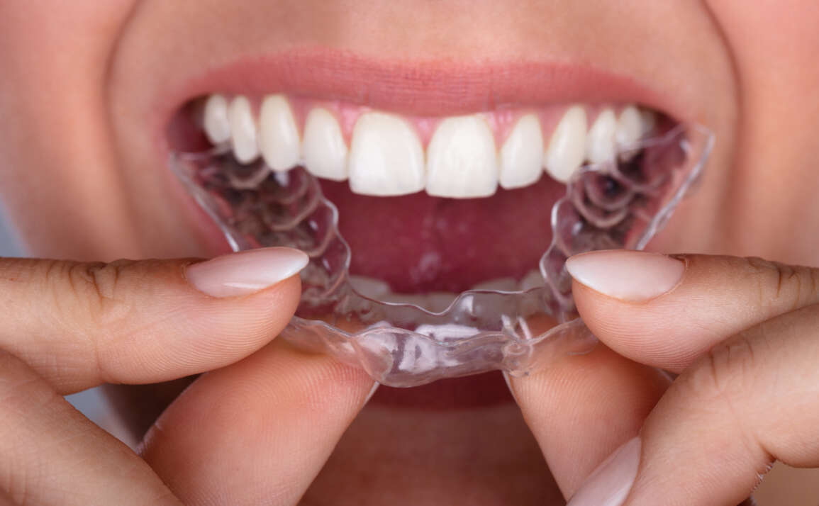 Frequently Asked Questions On Invisalign