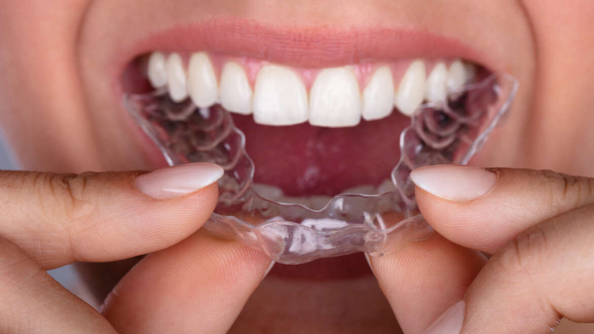 Frequently Asked Questions On Invisalign