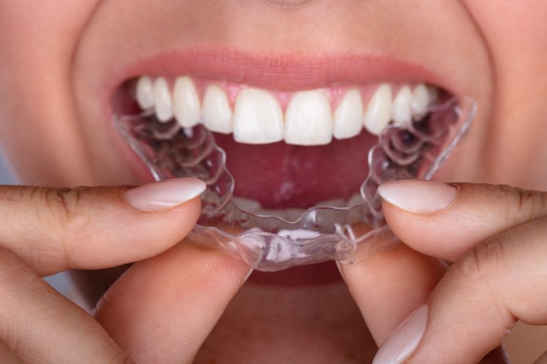 Frequently Asked Questions On Invisalign