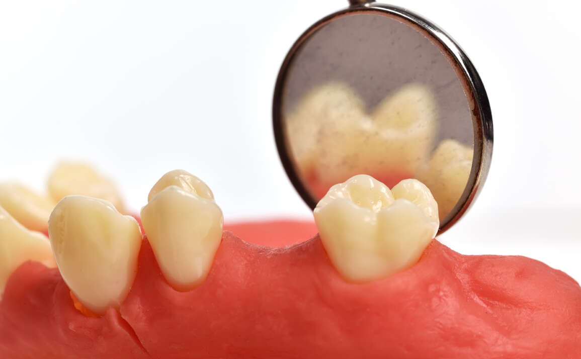 All About: Receding Gums