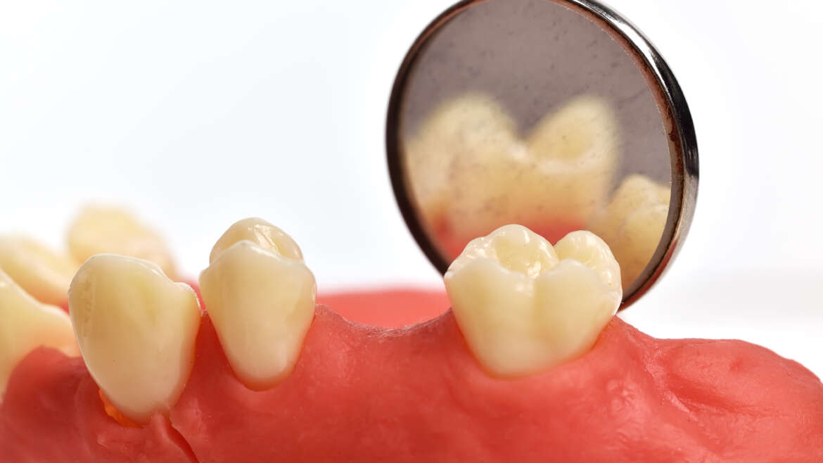 All About: Receding Gums