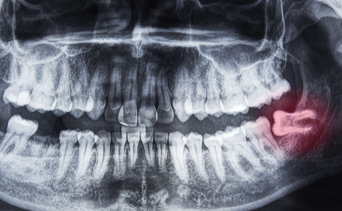 All about: Wisdom teeth