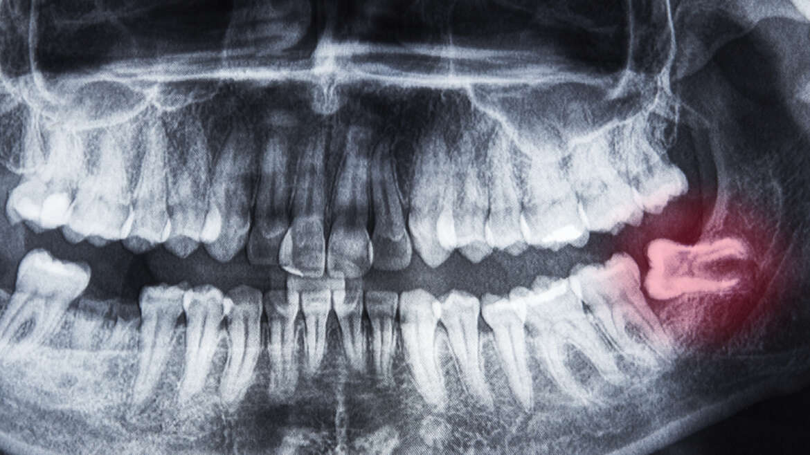 All about: Wisdom teeth