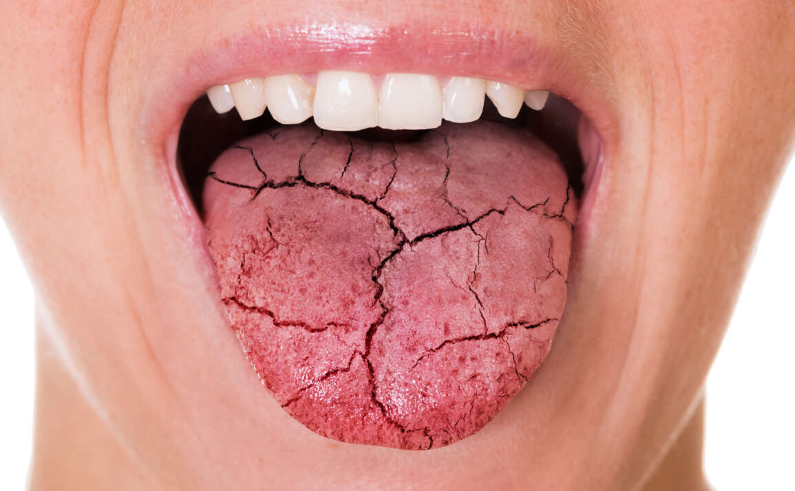 All About Dry Mouth