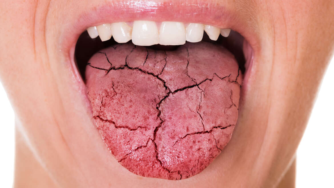 All About Dry Mouth