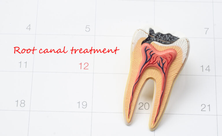 How to Care for a Root Canal