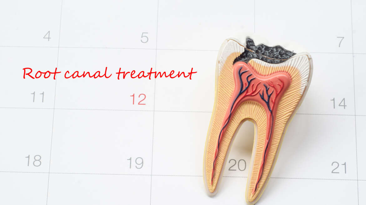 How to Care for a Root Canal