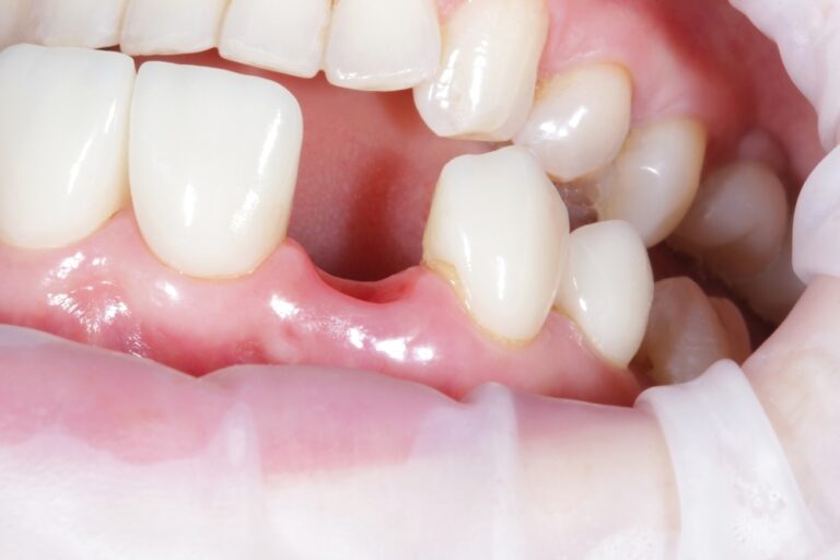 Frequently Asked Questions on Avulsed Tooth