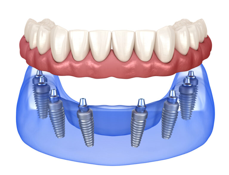 Five Things You Should Know About Implant-Supported Dentures