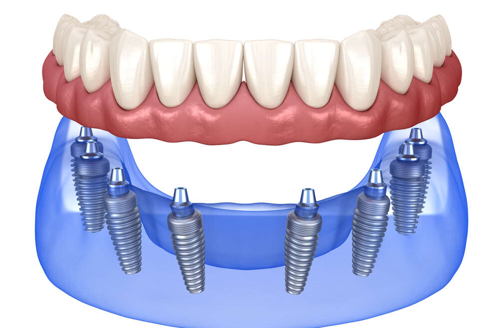 Five Things You Should Know About Implant-Supported Dentures