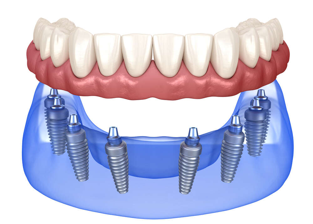 Five Things You Should Know About Implant-Supported Dentures