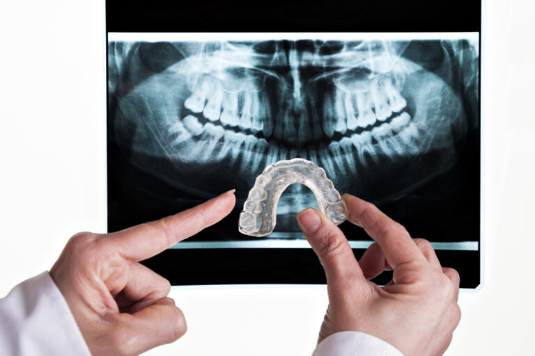 A Deeper Look Into Teeth Grinding