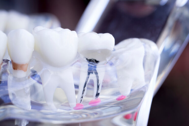 Beyond Pain Relief: The Aesthetic and Health Perks of Root Canal Therapy