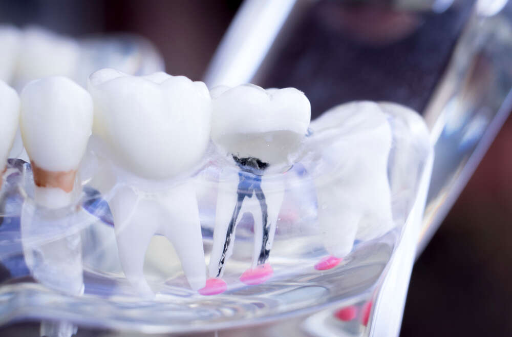 Beyond Pain Relief: The Aesthetic and Health Perks of Root Canal Therapy