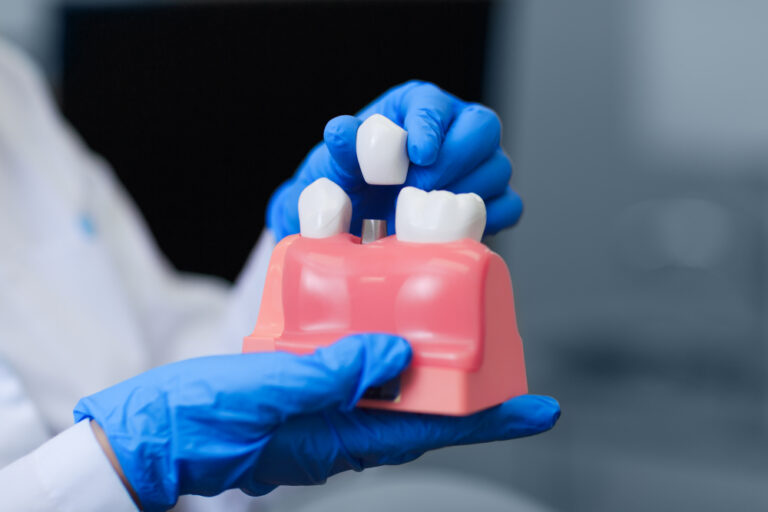 Five Things to Know About Dental Implants