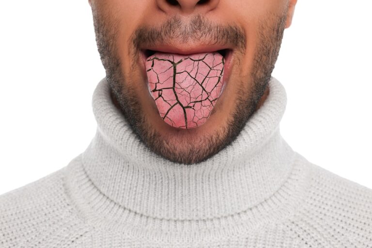 Winter Dryness: Navigating the Challenges of Dry Mouth During Cold Months