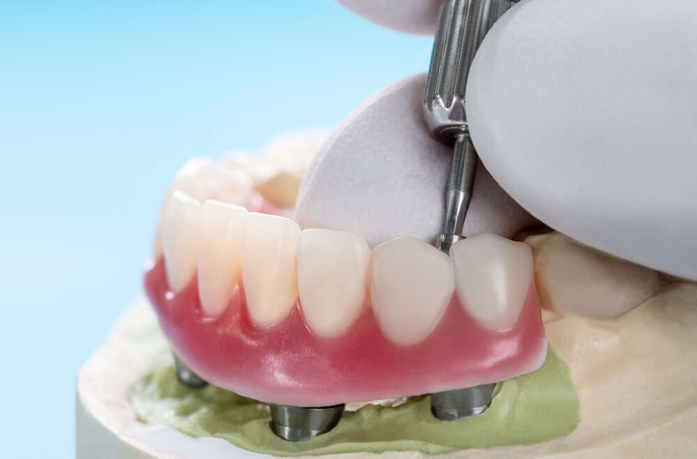 Secure Your Smile: The Freedom of Implant-Supported Dentures