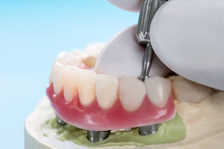 Secure Your Smile: The Freedom of Implant-Supported Dentures