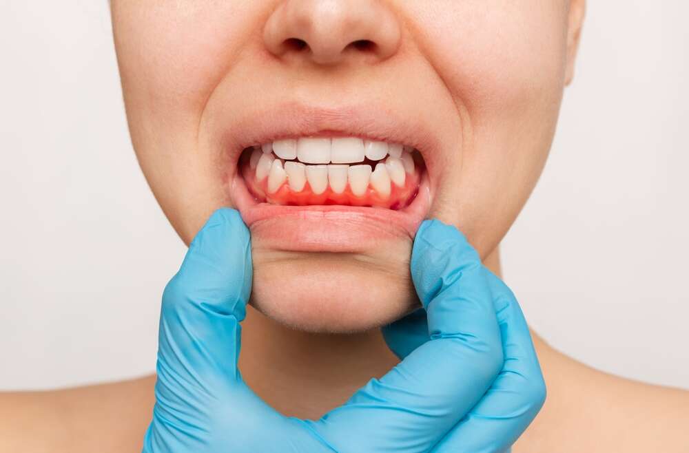 Gum Salvation: How Early Gum Disease Treatment Can Save Your Smile