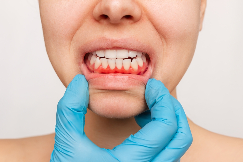 Gum Salvation: How Early Gum Disease Treatment Can Save Your Smile