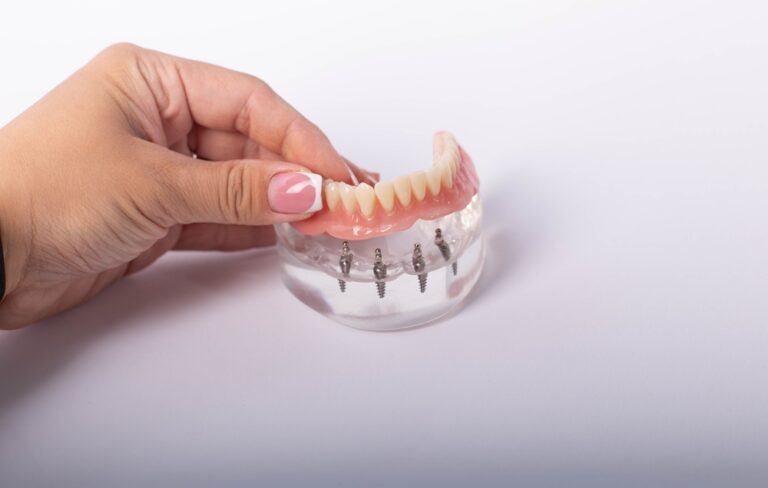 Redefining Smiles: The Science Behind All-on-4 Dental Implants