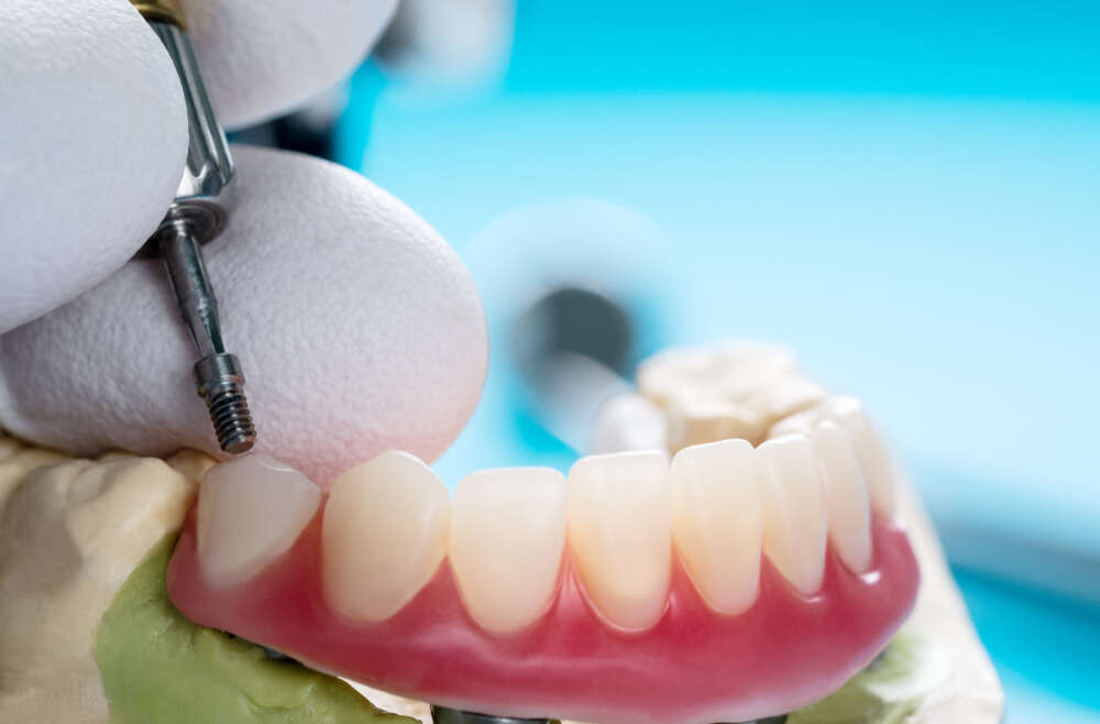 Eat, Speak, Smile: Enhancing Life Quality with Implant-Supported Dentures