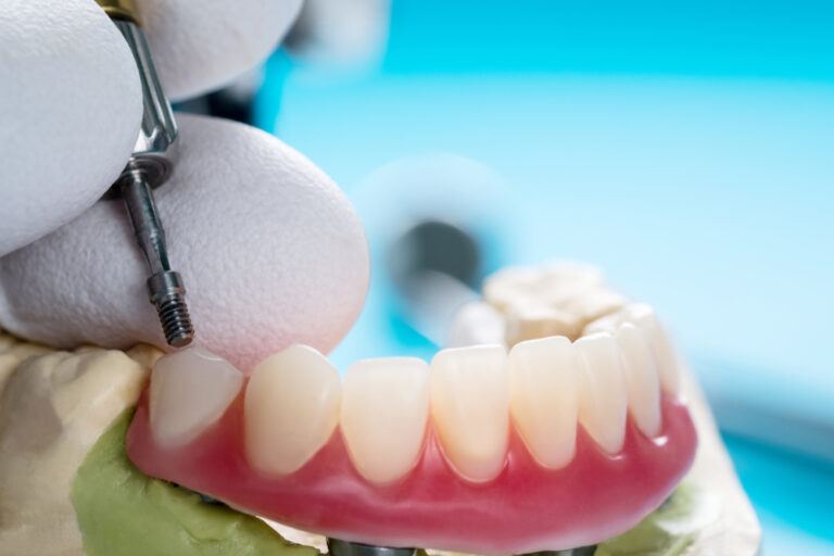 Eat, Speak, Smile: Enhancing Life Quality with Implant-Supported Dentures