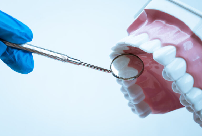 Maximizing Tooth Life: Dental Inlays & Onlays