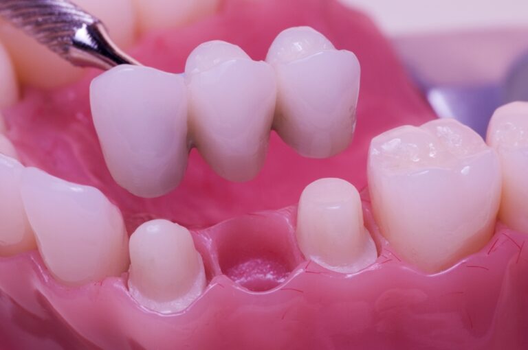 Transform Your Smile with Dental Bridges