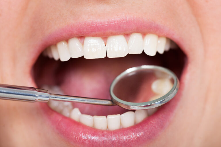 Dental Fillings: Materials, Process, and Aftercare