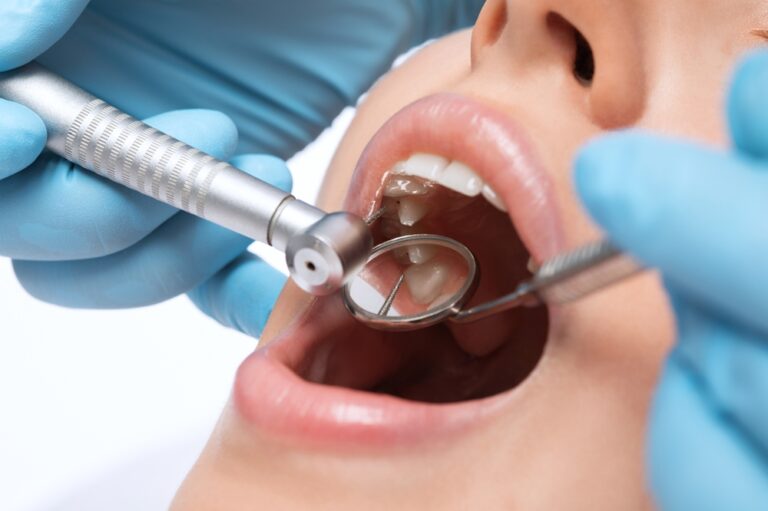 Dental Procedures: How Composite Fillings Restore Teeth