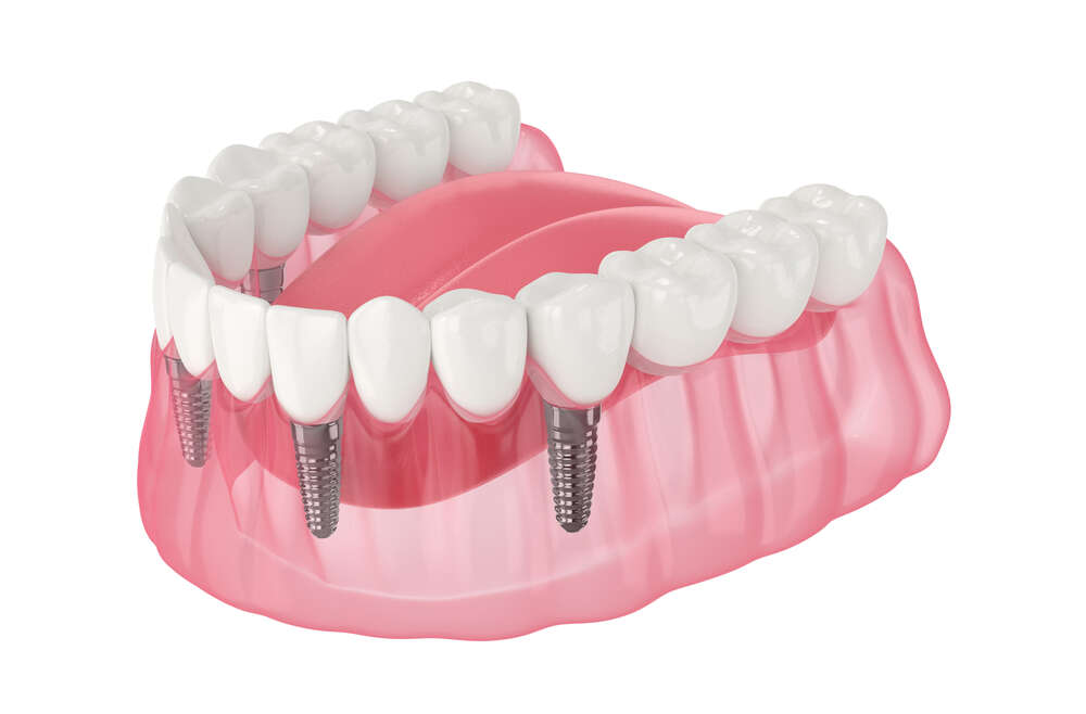 All-On-4 Dental Implants: Why Toronto Patients Are Making the Switch