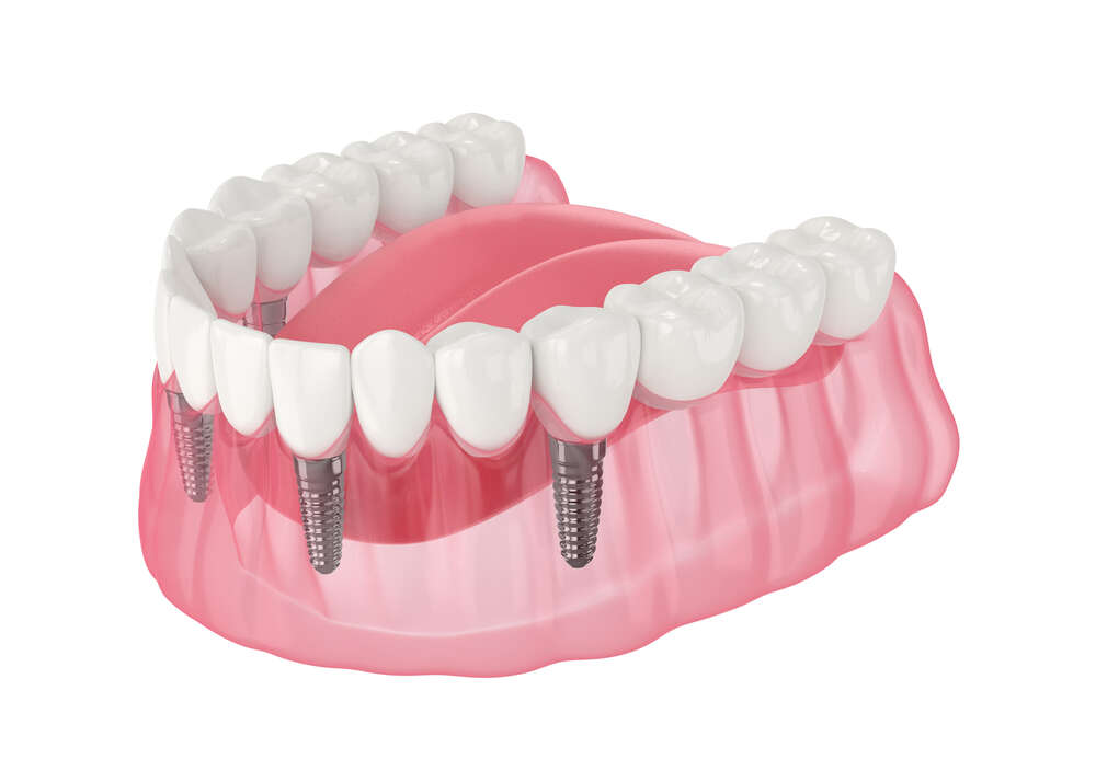 All-On-4 Dental Implants: Why Toronto Patients Are Making the Switch