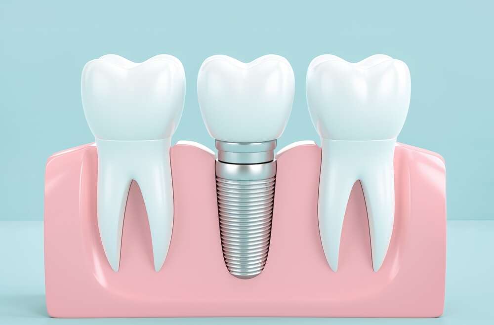 A Closer Look at Dental Implants and Pain
