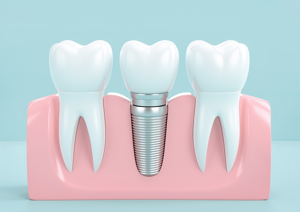 A Closer Look at Dental Implants and Pain