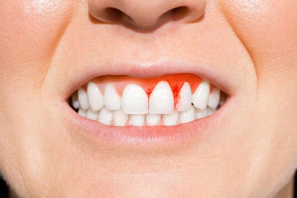 Bleeding Gums Aren’t Normal: What They Mean and What to Do