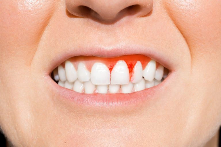 Bleeding Gums Aren’t Normal: What They Mean and What to Do