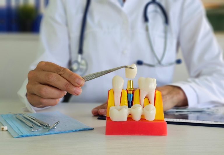 Ensuring Dental Implant Success