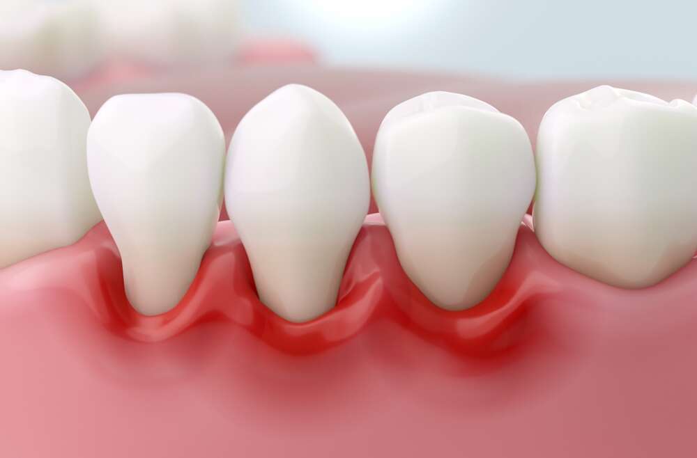 Diving into the Symptoms of Gum Disease