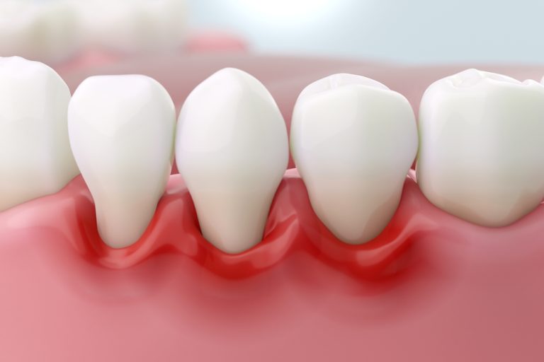 Diving into the Symptoms of Gum Disease